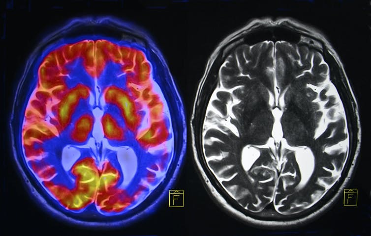 Afbeelding van een MRI-hersenscan.