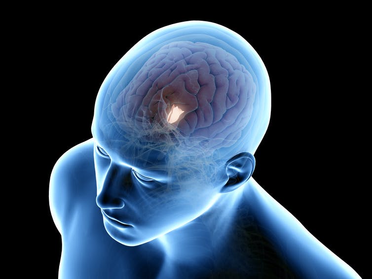 Afbeelding met de locatie van de hypothalamus in de hersenen.
