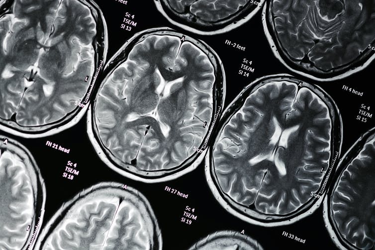 Beeld van fMRI-hersenscanbeelden.
