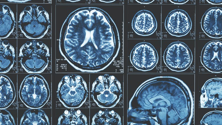 MRI beelden van het menselijk brein.