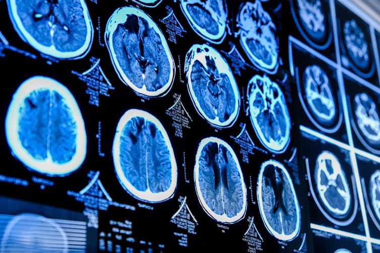 CT-scans van de hersenen.